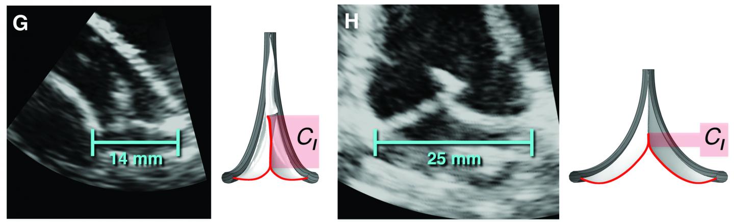 Size-Adjustable Prosthetic Heart Valve Accommodates Heart Growth in Sheep (2 of 8)