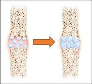 nano-artificial bone material