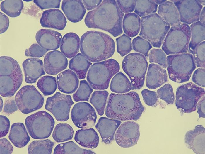 Luekemia cells