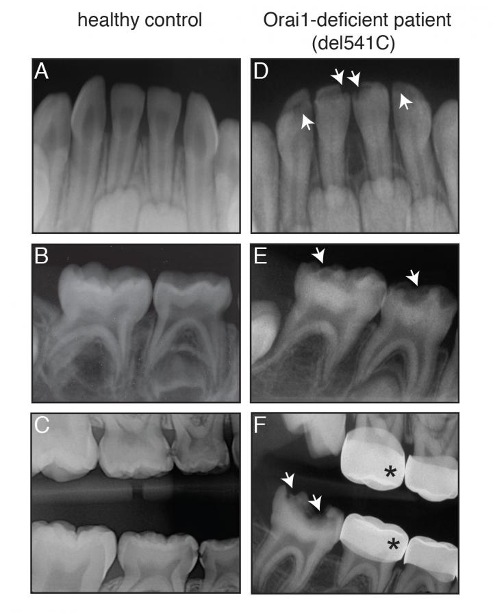 Case Study Reveals a Molecular Origin for Defective Tooth Enamel (1 of 1)