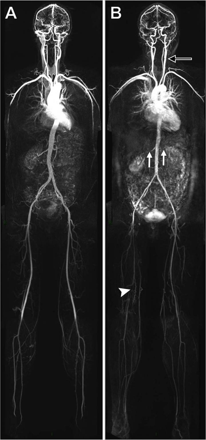 Examples of Whole-Body Angiograms