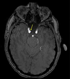 MR angiography image in a 35-year-old male shows a medially projecting intracranial aneurysm