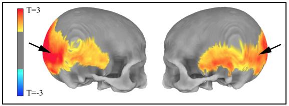 Skull Shape Changes Related to Neanderthal Gene Variants