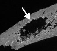 CT scan of bone from a medieval skull showing metastasis hidden within (white arrow)