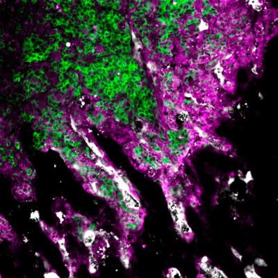 How Cancer Metastasizes To Bone