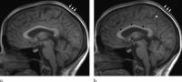Long Spaceflights Affect Astronaut Brain Volume