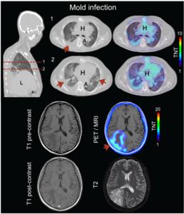 Representative 18F-FDS PET/CT and PET/MRI images of patients with pulmonary and cerebral invasive mold infections.