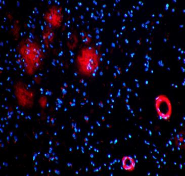 Plaques in Tissue