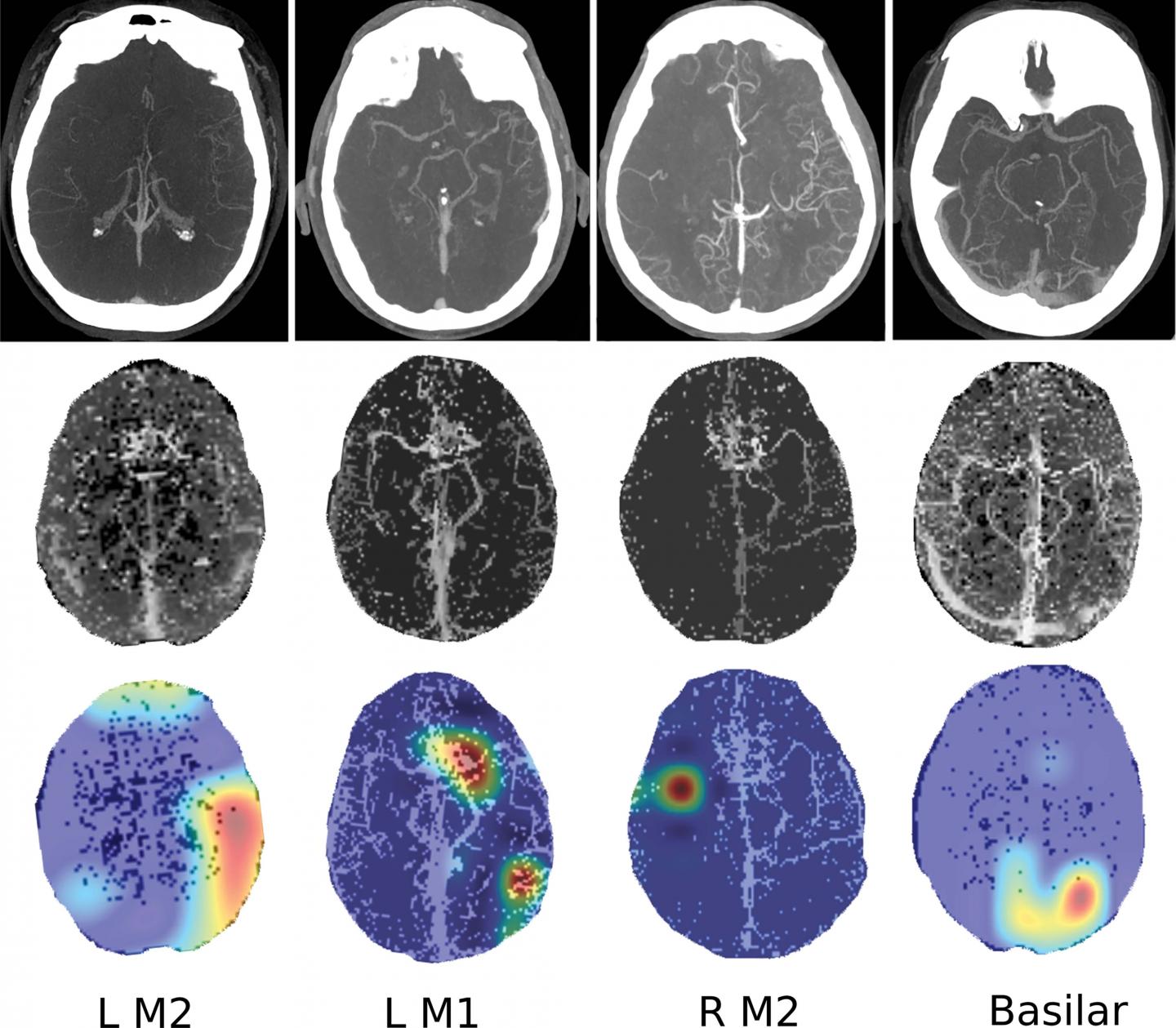 Deep Learning Model Provides Rapid Detection of Stroke-causing Blockages