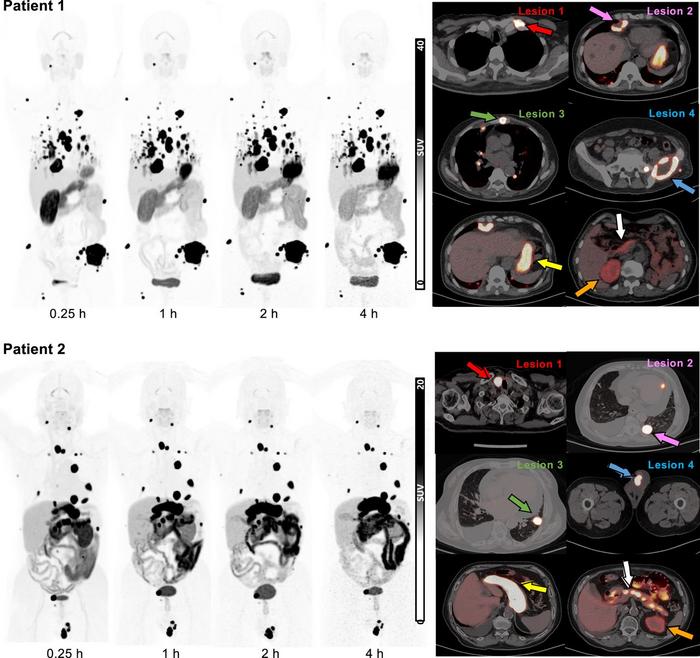 Serial whole-body maximum-intensity projections over time and representative transaxial images at one hour postinjection of 68Ga-NYM096.