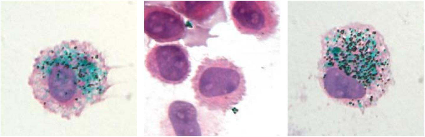 Tattoo Pigment Can Be Recaptured by New Macrophages