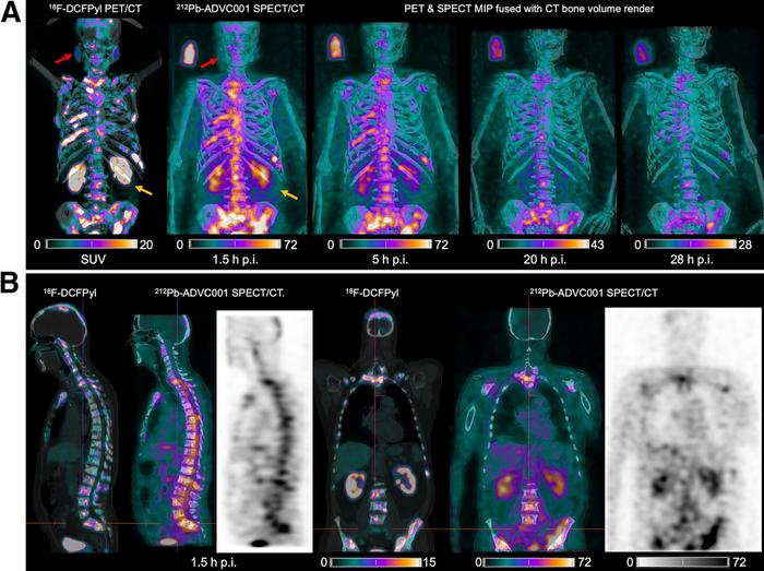 18F-DCFPyl PET/CT and 212Pb SPECT/CT Images