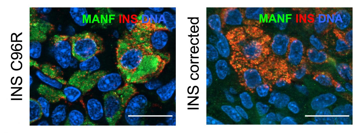 Stem Cell-Derived Pancreatic Beta Cells
