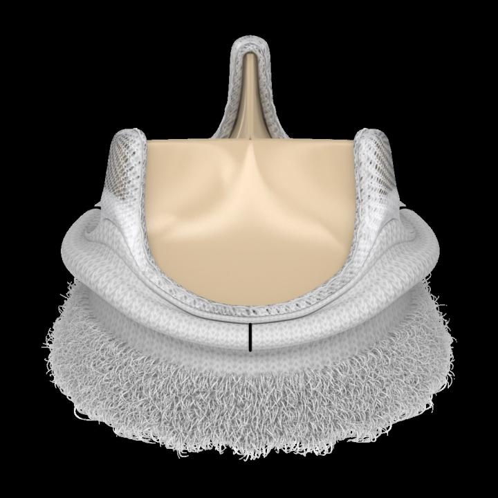 Implantation of Rapid Deployment Aortic Valve Found to Be Durable, Safe, and Effective