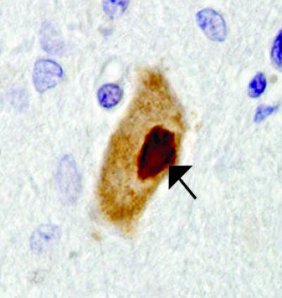 ALS Neuron