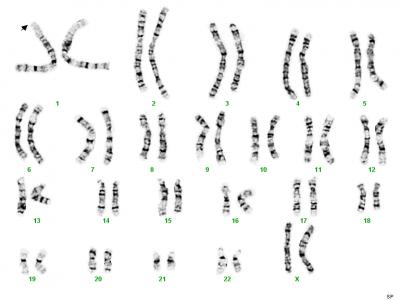 Jacobsen Syndrome