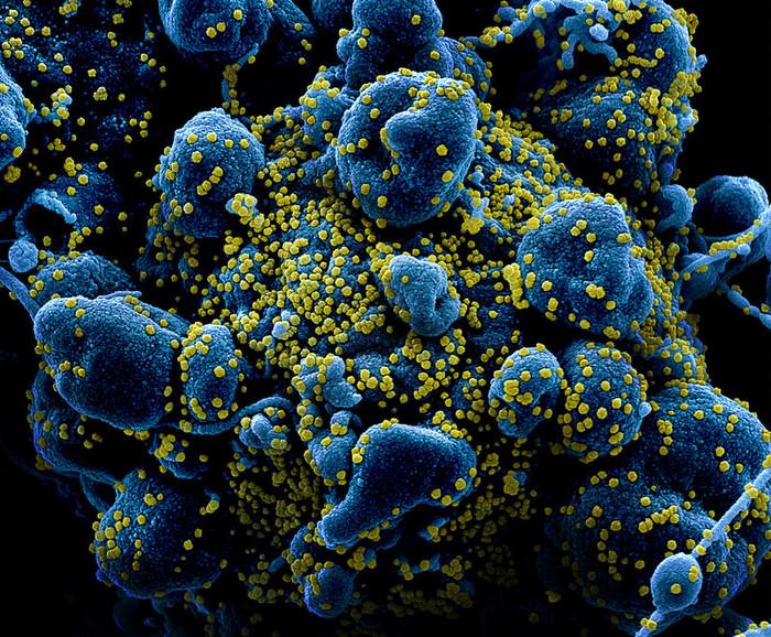 Cell heavily infected with SARS-COV-2