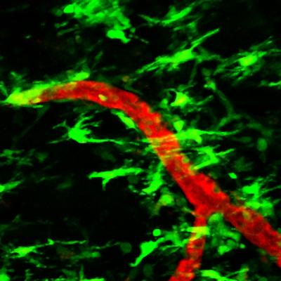 Fibrinogen Leakage May Trigger MS Nerve Damage