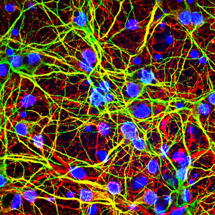 West Nile Virus Brain Infection