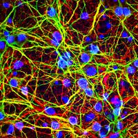 West Nile Virus Brain Infection