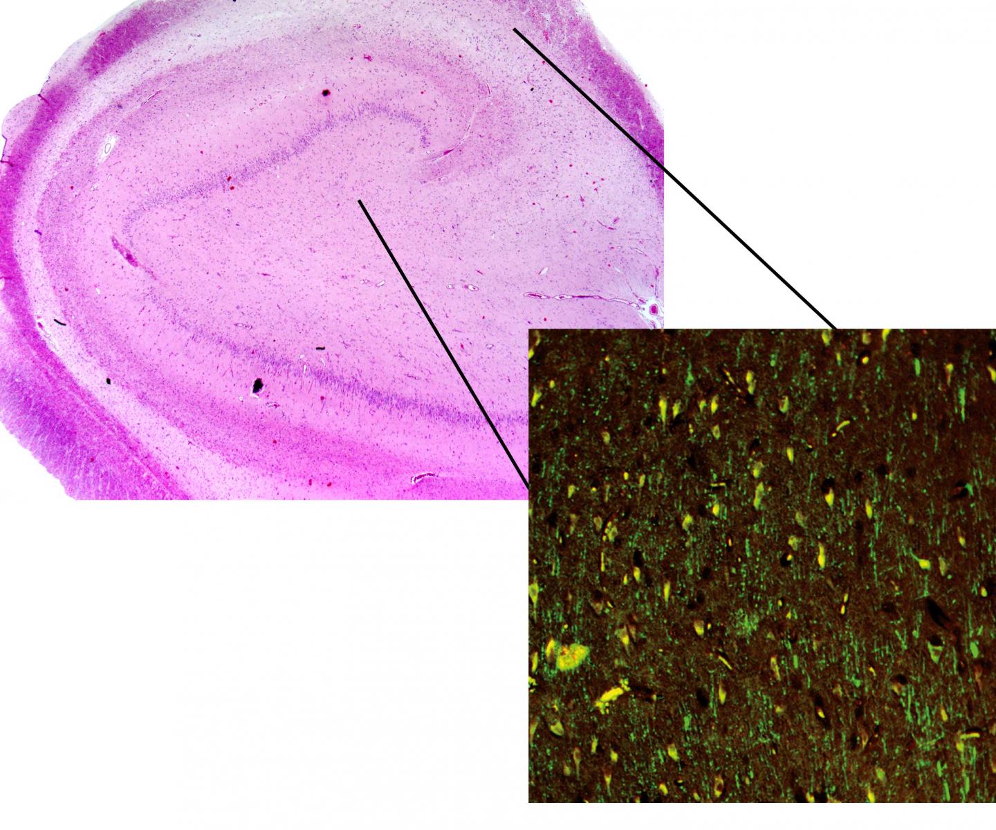Surgical Specimen of an Antiepileptic-Resistant Patient