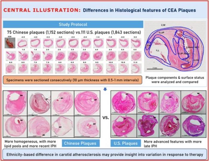 Ethnicity-Based Differences in Histological Features of Carotid Endarterectomy Plaques