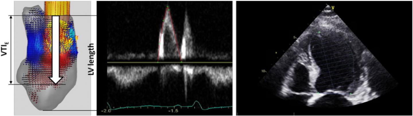Measurement of E-Wave Propagation Index (EPI)