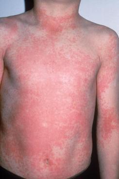Scarlet Fever Makes a Comeback