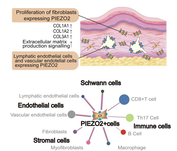Cells expressing PIEZO2 mechanoreceptors may drive the pathology of keloids