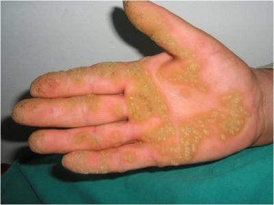 Lesions of Palmoplantar Keratoderma (PKK) on Palm