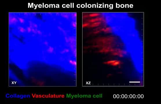 Tumor Cells Colonizing Bone