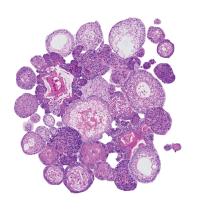 Collage of Head and Neck Cancer Organoids