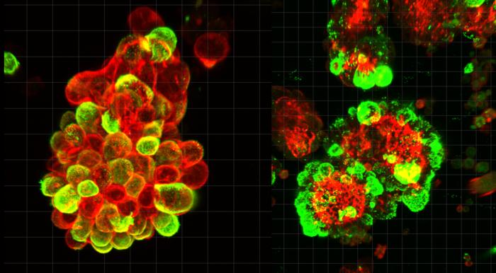 Cancer and mesothelial cells form hybrid spheres