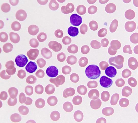 CLL