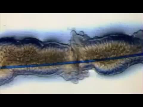Bowel Bridging (2 of 2)