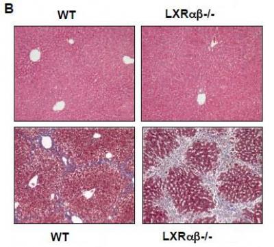 Liver Fibrosis