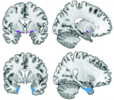 Origins of Alzheimer's