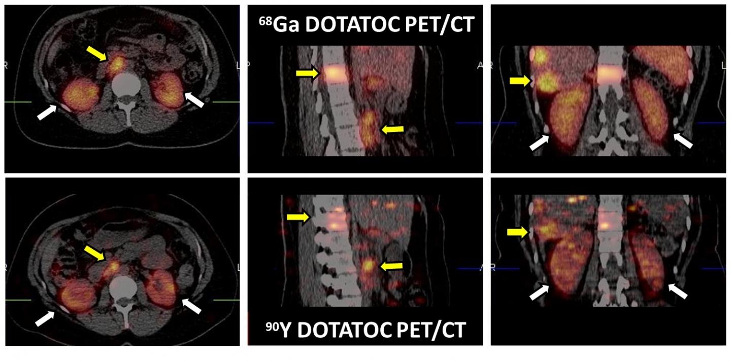 Comparison of Ga-68-DOTATOC PET/CT with Y-90 DOTATOC PET/CT