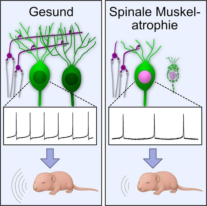 In severe spinal muscular atrophy, nerve cells in the cerebellum lose vital connections: synapses of the granule cells (magenta) degenerate, and Purkinje cells (green) die.