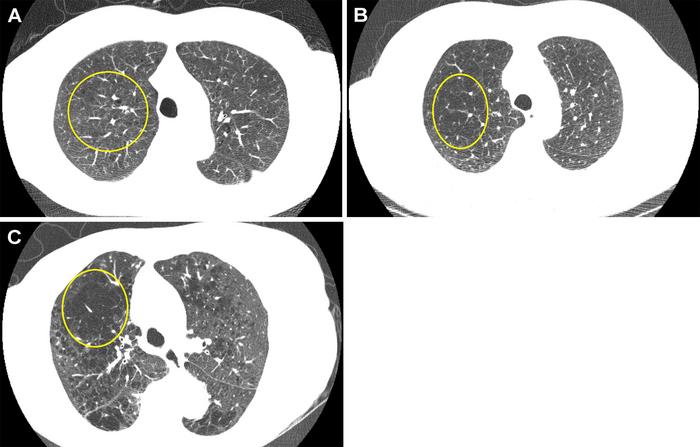 Representative axial images of mild, moderate, and severe emphysema at baseline low-dose CT.