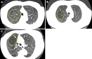 Representative axial images of mild, moderate, and severe emphysema at baseline low-dose CT.