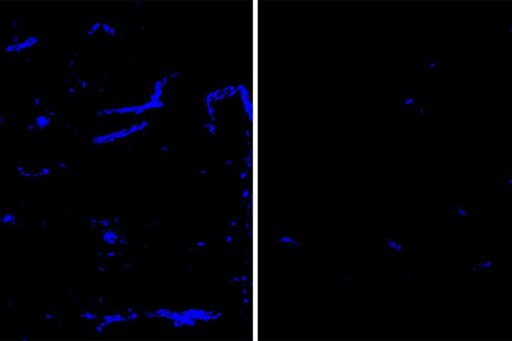Anti-APOE antibody removes amyloid plaques