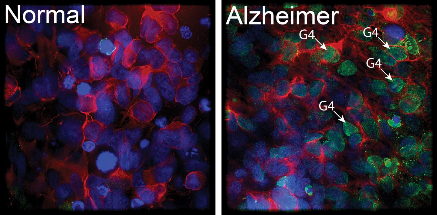 Alzheimer's Disease