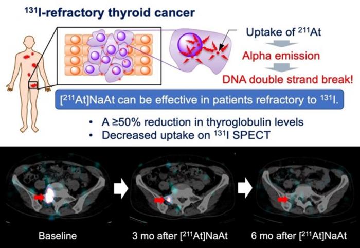 [211At]NaAt can be effective in patients refractory to radioactive iodine.