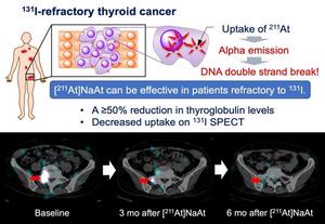 [211At]NaAt can be effective in patients refractory to radioactive iodine.