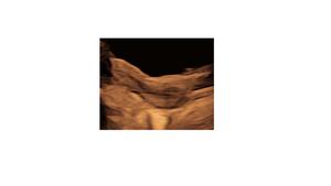 Paracetamol use during pregnancy is linked to changed reproductive development in daughters