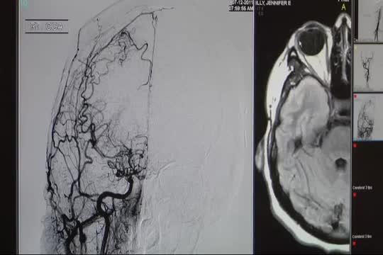 Strokes up Sharply in the Young, Still Most Avoid ER
