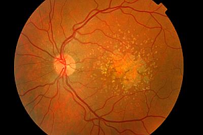 Macular Degeneration