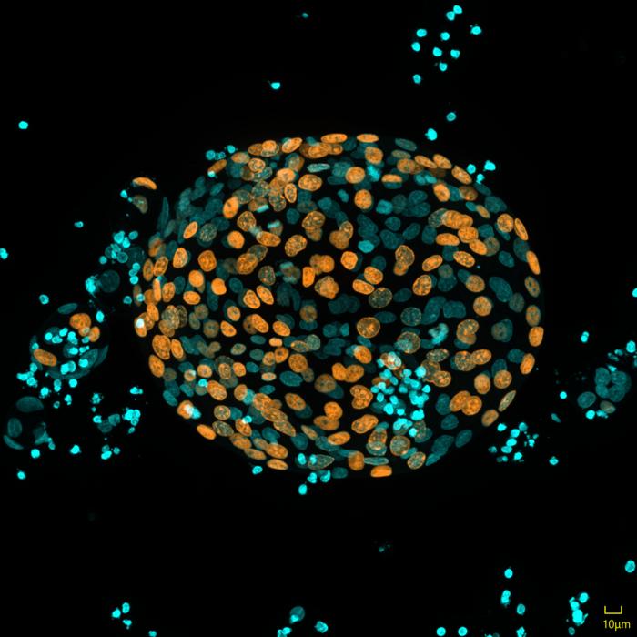 Chronic pancreatitis organoids