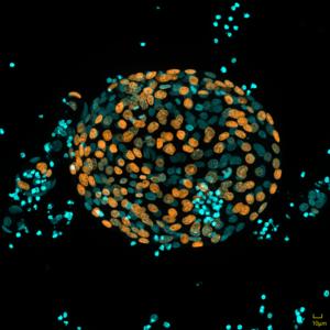 Chronic pancreatitis organoids